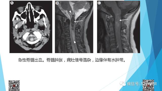 【PPT】脊髓常见血管性病变的临床与影像