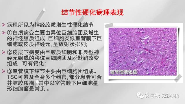 【PPT】影像科普：结节性硬化症