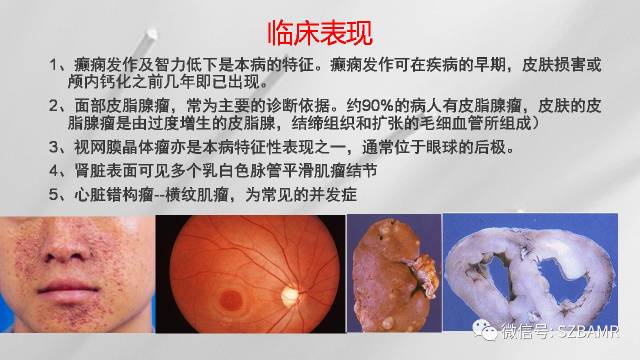 【PPT】影像科普：结节性硬化症