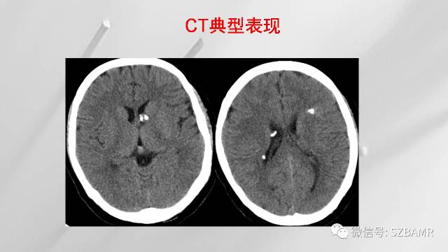 【PPT】影像科普：结节性硬化症