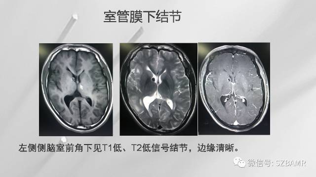【PPT】影像科普：结节性硬化症