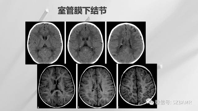 【PPT】影像科普：结节性硬化症