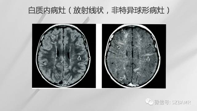 【PPT】影像科普：结节性硬化症