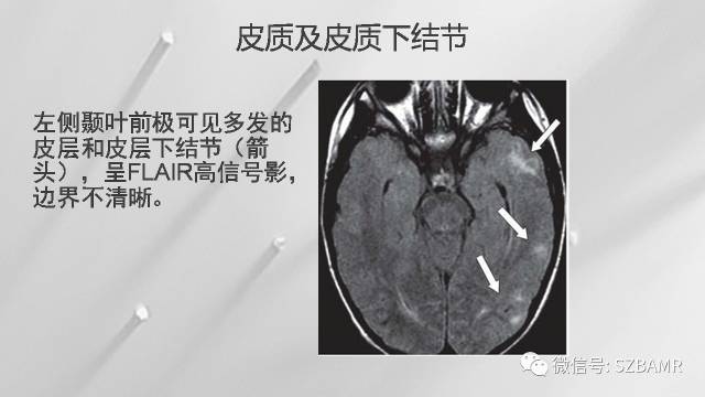 【PPT】影像科普：结节性硬化症