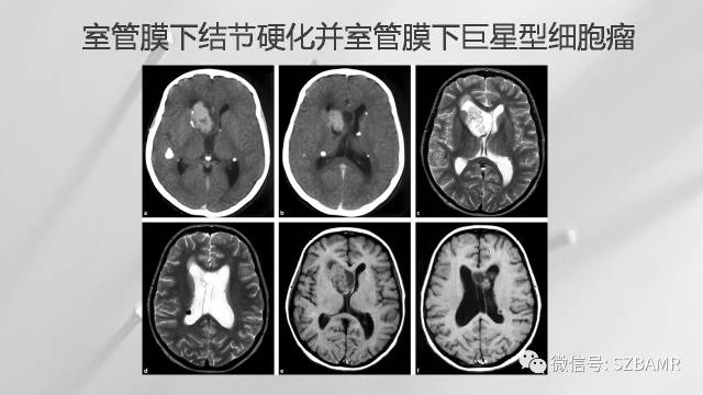 【PPT】影像科普：结节性硬化症