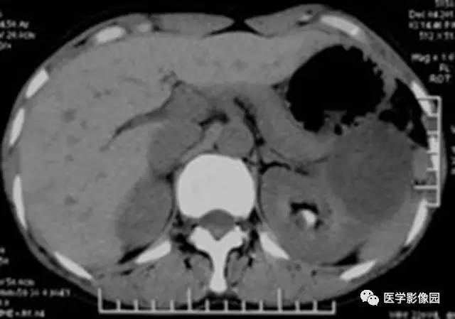 【病例】多房性囊性肾癌1例CT影像表现 【病例】多房性囊性肾癌1例CT影像表现