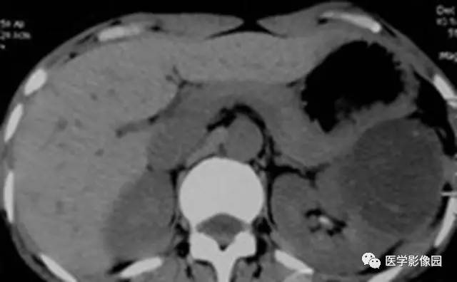 【病例】多房性囊性肾癌1例CT影像表现 【病例】多房性囊性肾癌1例CT影像表现