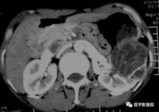 【病例】多房性囊性肾癌1例CT影像表现 【病例】多房性囊性肾癌1例CT影像表现