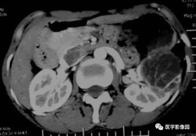 【病例】多房性囊性肾癌1例CT影像表现 【病例】多房性囊性肾癌1例CT影像表现