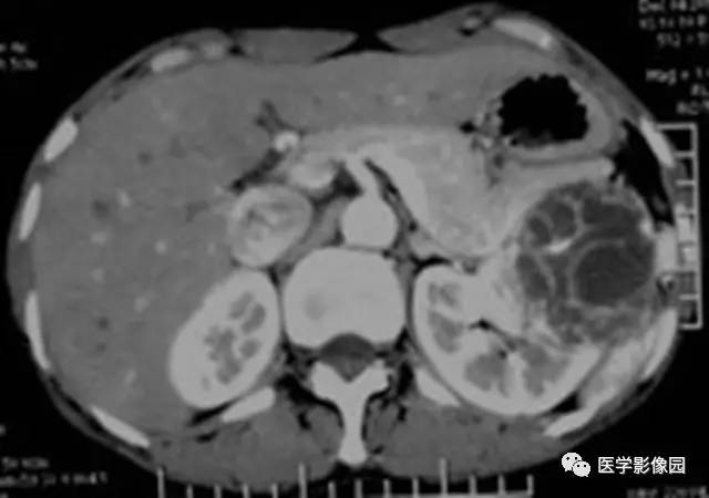 【病例】多房性囊性肾癌1例CT影像表现 【病例】多房性囊性肾癌1例CT影像表现