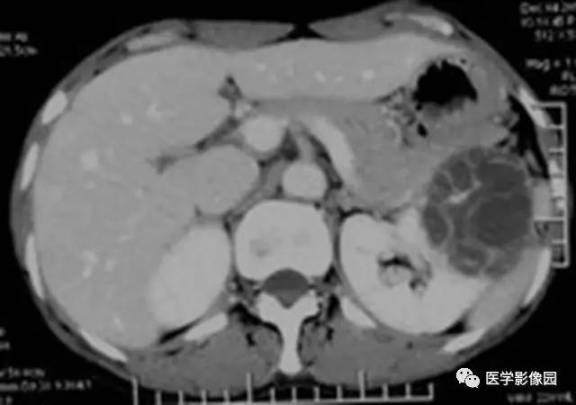 【病例】多房性囊性肾癌1例CT影像表现 【病例】多房性囊性肾癌1例CT影像表现