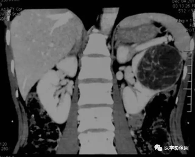 【病例】多房性囊性肾癌1例CT影像表现 【病例】多房性囊性肾癌1例CT影像表现