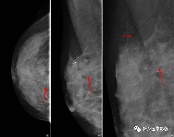 乳腺阅片中最易忽略的两个区域——银河区与无人区