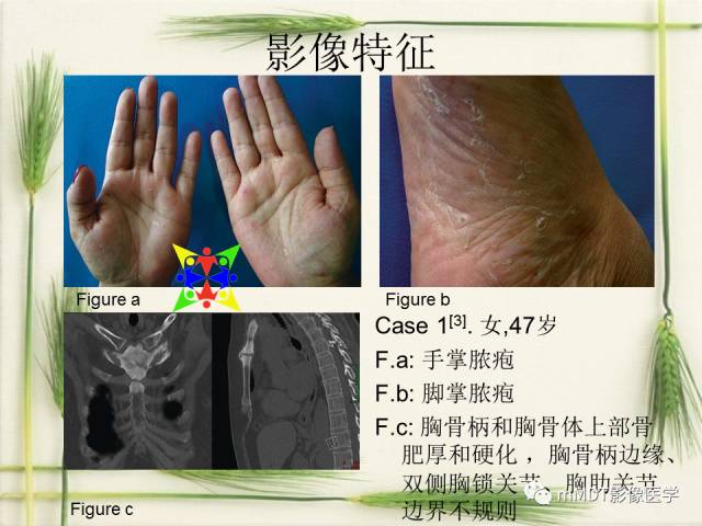 【PPT】SAPHO综合症