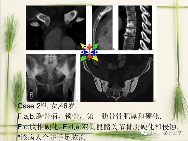 【PPT】SAPHO综合症