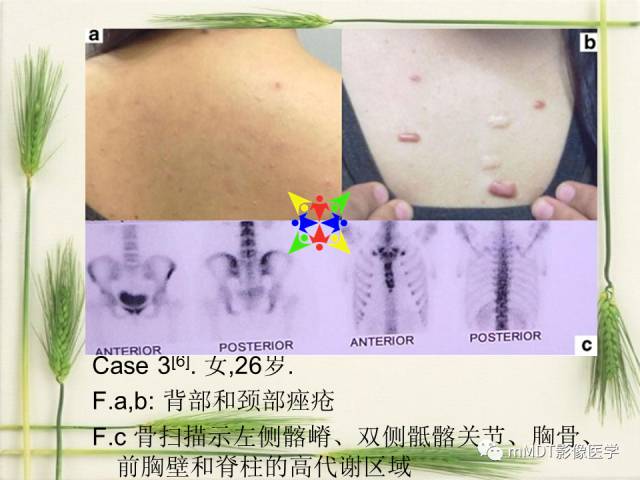 【PPT】SAPHO综合症