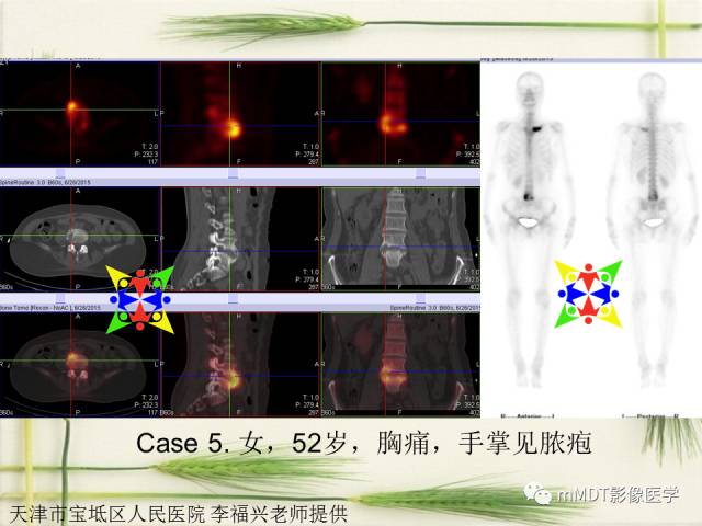 【PPT】SAPHO综合症