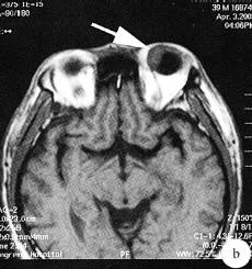 【病例】左侧眼球内炎性假瘤1例CT及MR 【病例】左侧眼球内炎性假瘤1例CT及MR