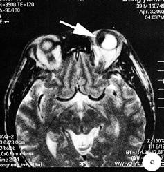 【病例】左侧眼球内炎性假瘤1例CT及MR 【病例】左侧眼球内炎性假瘤1例CT及MR