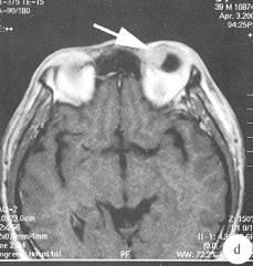 【病例】左侧眼球内炎性假瘤1例CT及MR 【病例】左侧眼球内炎性假瘤1例CT及MR