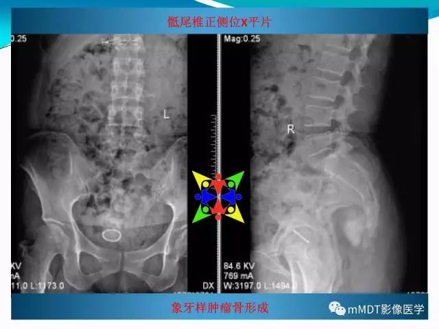 【PPT】骶尾椎病变的诊断思路