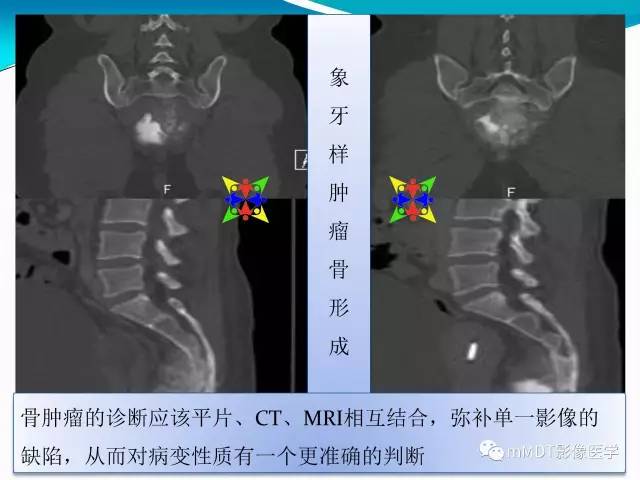【PPT】骶尾椎病变的诊断思路