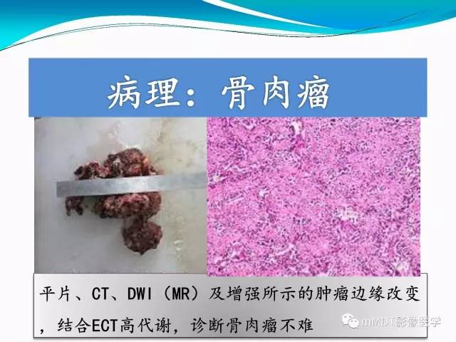 【PPT】骶尾椎病变的诊断思路