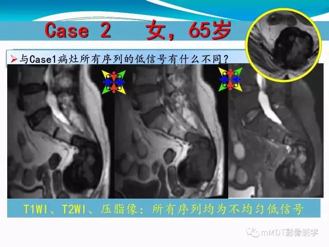 【PPT】骶尾椎病变的诊断思路