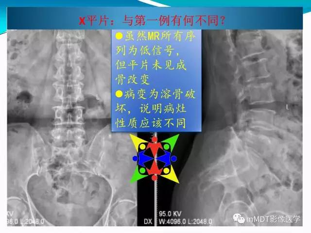 【PPT】骶尾椎病变的诊断思路