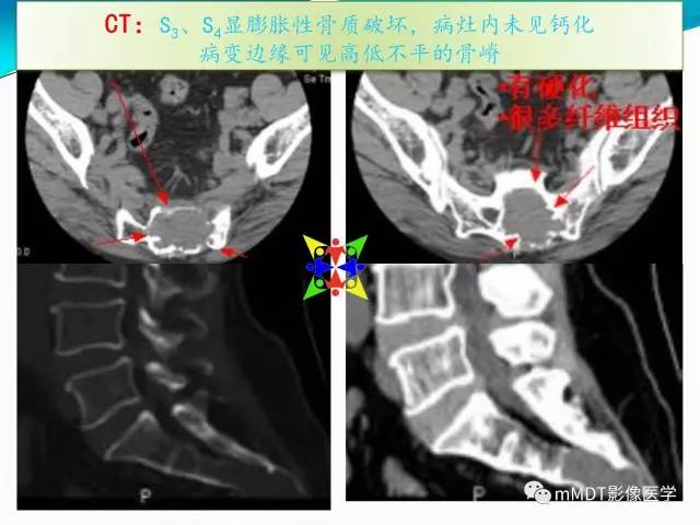 【PPT】骶尾椎病变的诊断思路