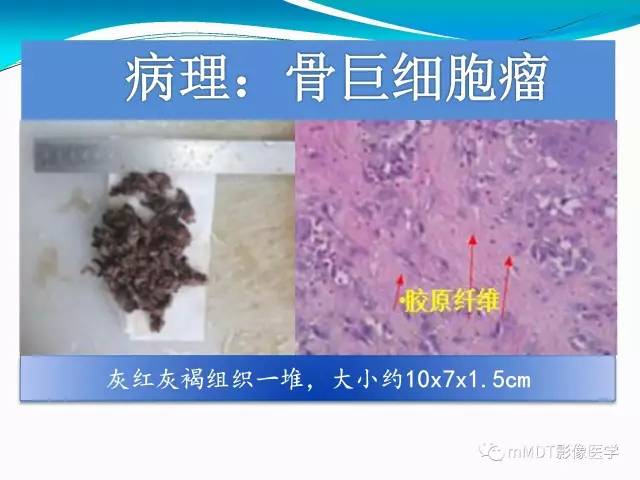 【PPT】骶尾椎病变的诊断思路