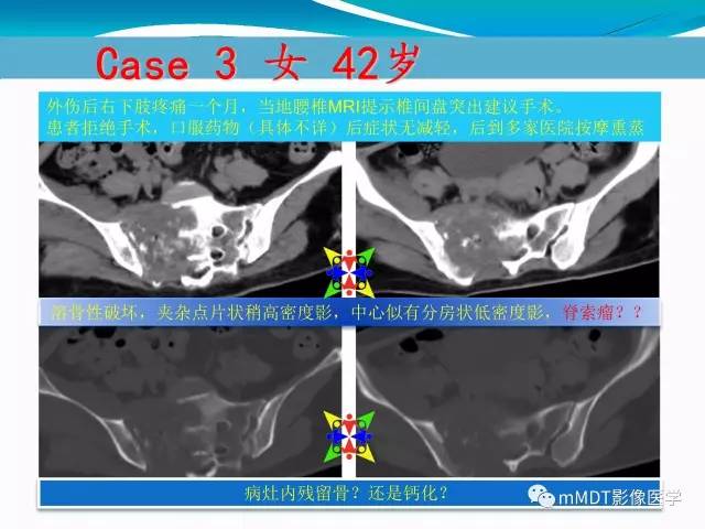 【PPT】骶尾椎病变的诊断思路