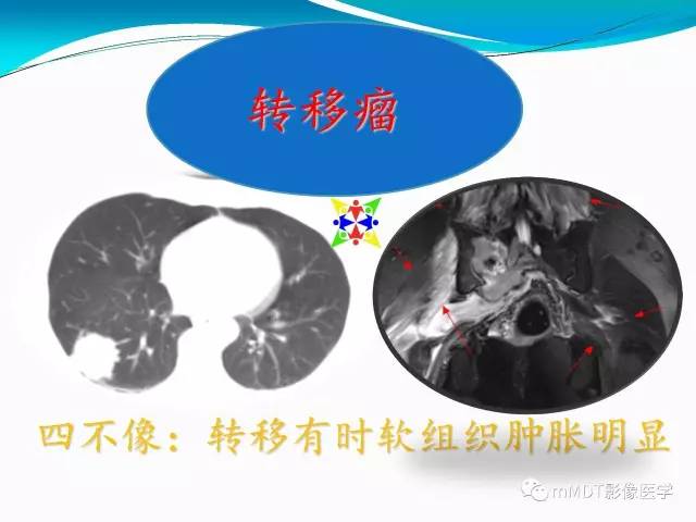 【PPT】骶尾椎病变的诊断思路