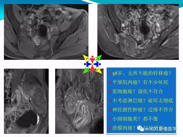 【PPT】骶尾椎病变的诊断思路
