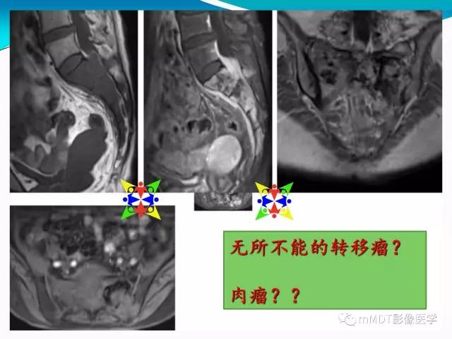 【PPT】骶尾椎病变的诊断思路