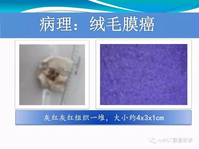 【PPT】骶尾椎病变的诊断思路
