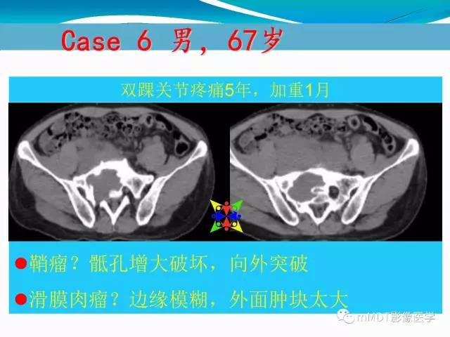 【PPT】骶尾椎病变的诊断思路