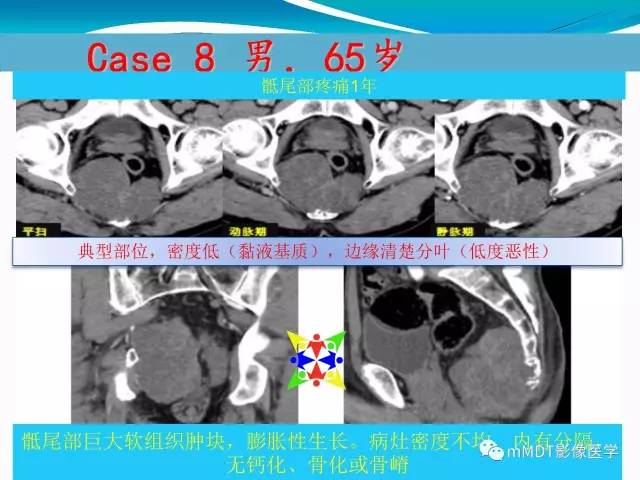 【PPT】骶尾椎病变的诊断思路