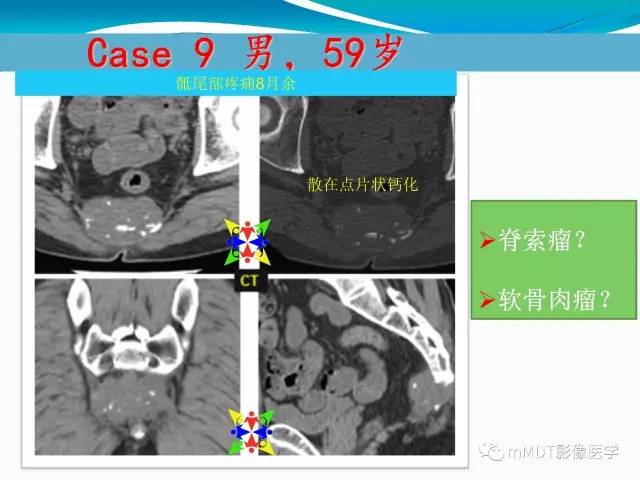 【PPT】骶尾椎病变的诊断思路