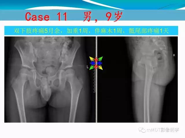 【PPT】骶尾椎病变的诊断思路