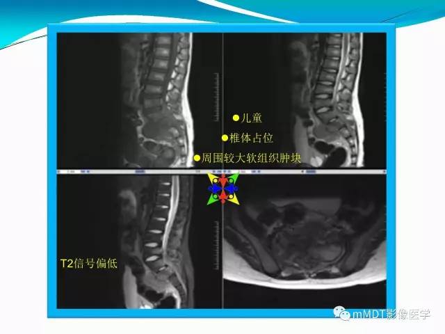 【PPT】骶尾椎病变的诊断思路