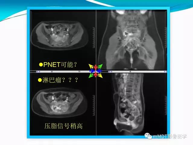 【PPT】骶尾椎病变的诊断思路