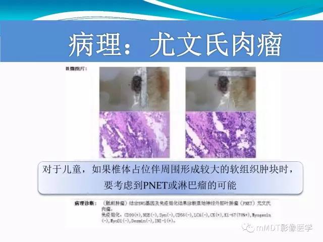 【PPT】骶尾椎病变的诊断思路