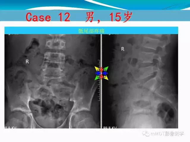 【PPT】骶尾椎病变的诊断思路