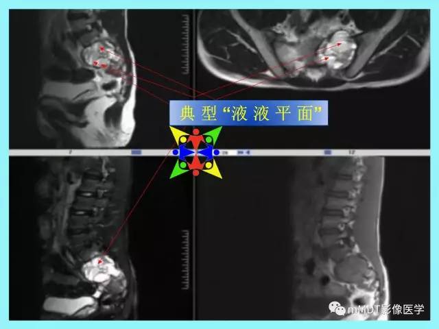 【PPT】骶尾椎病变的诊断思路