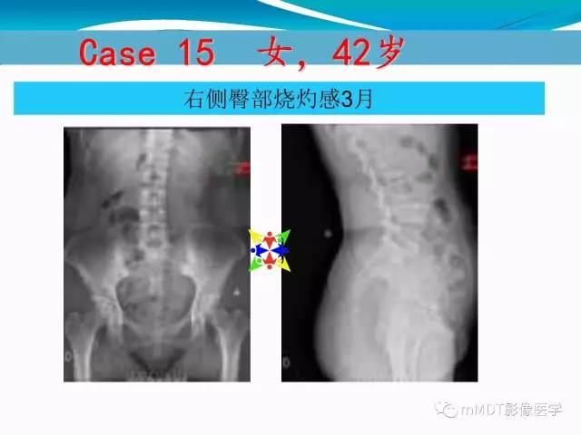 【PPT】骶尾椎病变的诊断思路