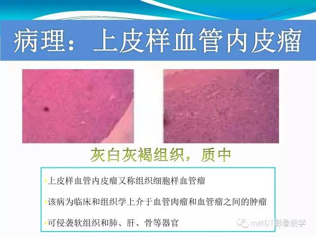 【PPT】骶尾椎病变的诊断思路