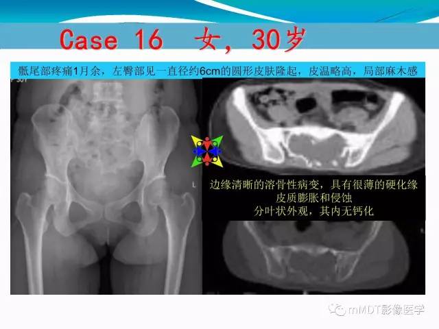 【PPT】骶尾椎病变的诊断思路