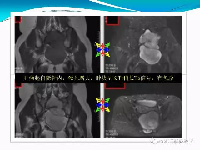 【PPT】骶尾椎病变的诊断思路