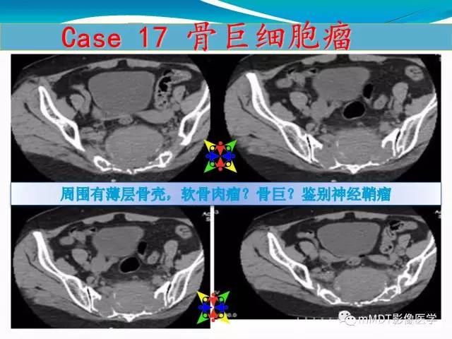 【PPT】骶尾椎病变的诊断思路